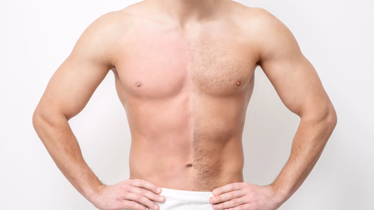 Primo piano del torso di un uomo con met&agrave; del petto e dell&rsquo;addome depilati e l&rsquo;altra met&agrave; con peli naturali, creando un chiaro contrasto tra le due parti. Indossa solo un asciugamano bianco intorno alla vita e ha le mani sui fianchi. L&rsquo;immagine evidenzia il prima e dopo della depilazione maschile.